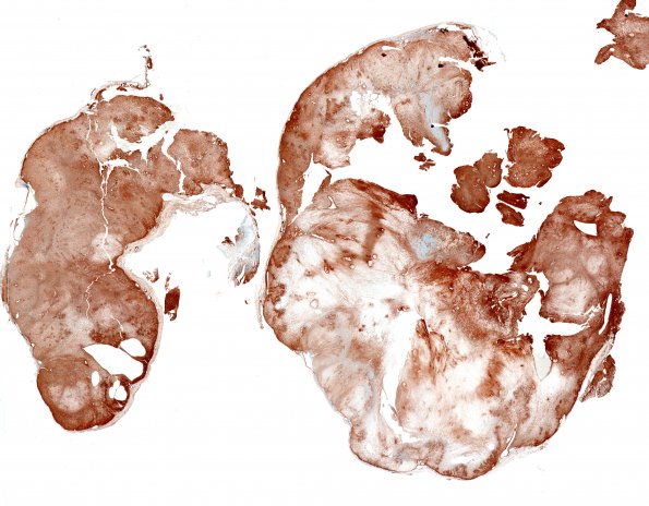 4C Schwannoma (Case 4) CollIV WM