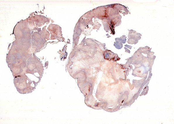 4D1 Schwannoma (Case 4) GFAP WM