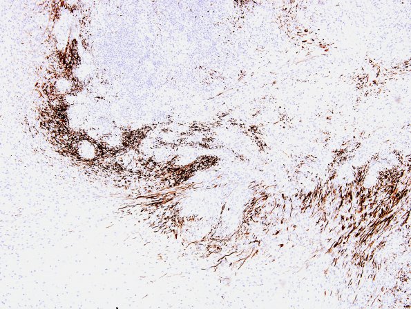 4D2 Schwannoma (Case 4) series A GFAP 2