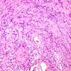 5B2 Schwannoma (Case 5) H&E 1