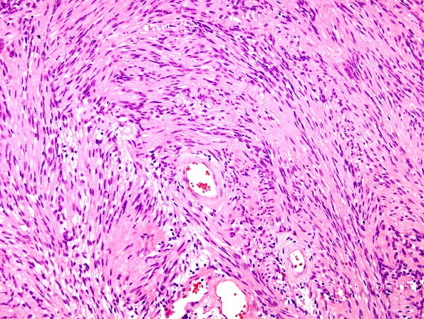 5B2 Schwannoma (Case 5) H&E 1