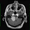 6A Schwannoma (Case 6) T1 W 1 - Copy