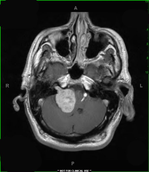 6A Schwannoma (Case 6) T1 W 1 - Copy