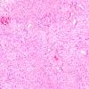 6B1 Schwannoma (Case 6) H&E 10X