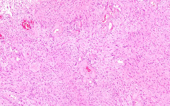 6B1 Schwannoma (Case 6) H&E 10X