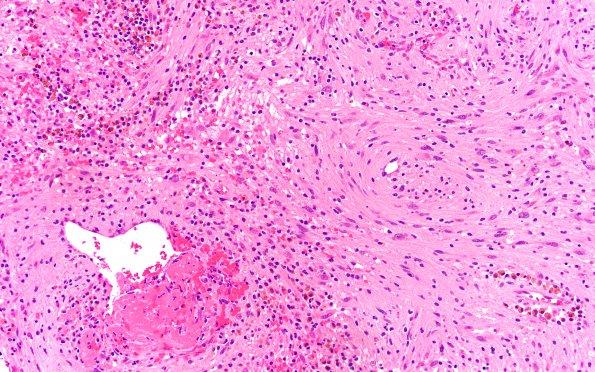 6B2 Schwannoma (Case 6) H&E 20X