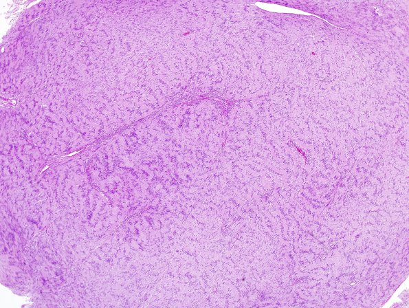 7A1 Schwannoma (Case 7) H&E 1