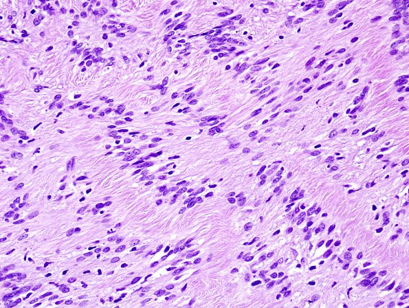 7A2 Schwannoma (Case 7) H&E 4