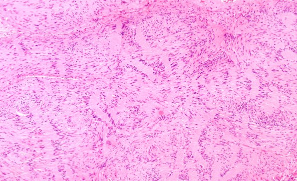 8A Schwannoma (Case 8) H&E 1