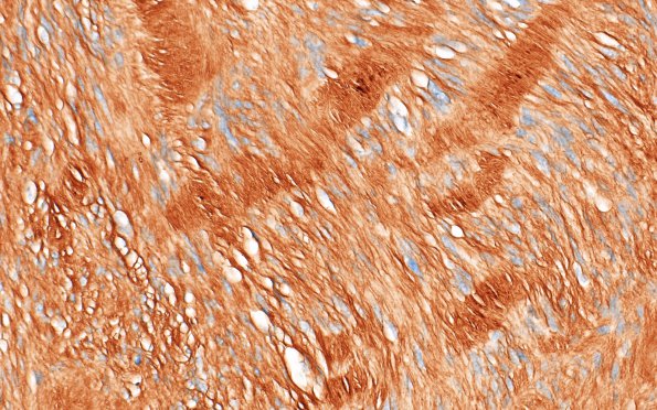 8B2 Schwannoma (Case 8) Coll IV 1