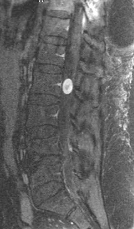 9A1 Schwannoma (Case 9) T1 W 3 - Copy