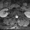 9A2 Schwannoma (Case 9) T1 W 1 - Copy