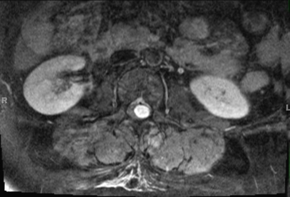 9A2 Schwannoma (Case 9) T1 W 1 - Copy