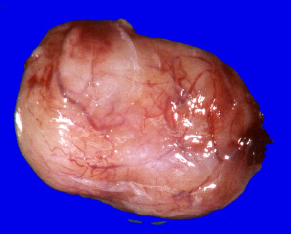 9B1 Schwannoma (Case 9) Gross _1