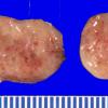 9B2 Schwannoma (Case 9) Gross _2