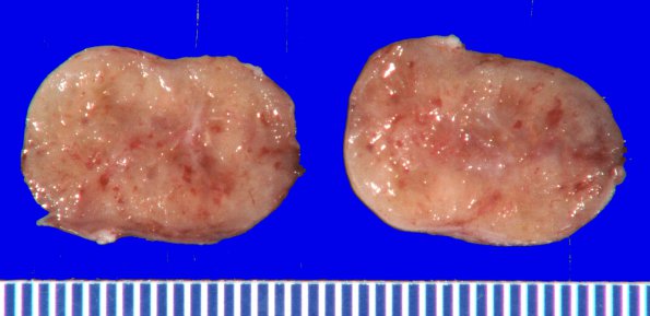 9B2 Schwannoma (Case 9) Gross _2