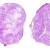 9C1 Schwannoma (Case 9) H&E whole mount