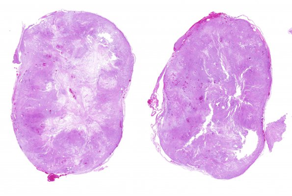 9C1 Schwannoma (Case 9) H&E whole mount