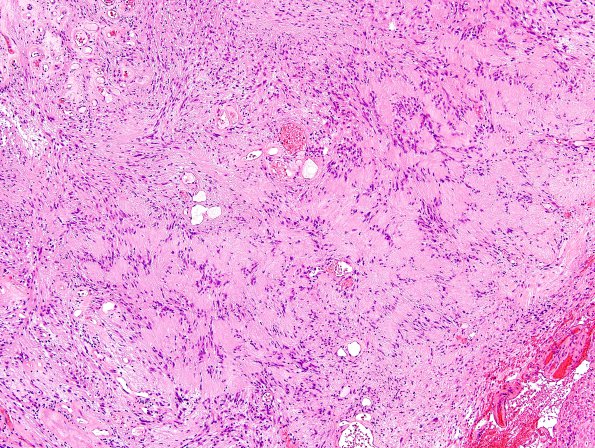 9C2 Schwannoma (Case 9) H&E 4.jpg