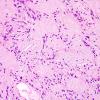 9C3 Schwannoma (Case 9) H&E 5.jpg