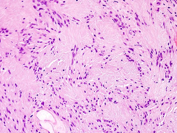 9C3 Schwannoma (Case 9) H&E 5.jpg