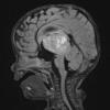 1A1 ALK-positive Histiocytosis (Case 1) FLAIR with C - Copy