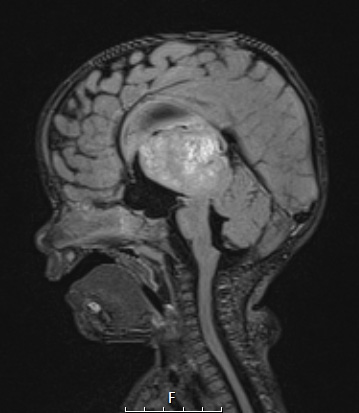 1A1 ALK-positive Histiocytosis (Case 1) FLAIR with C - Copy