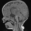 1A2 ALK-positive Histiocytosis (Case 1) T1 no C - Copy