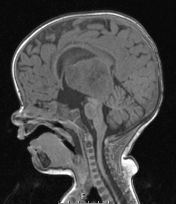 1A2 ALK-positive Histiocytosis (Case 1) T1 no C - Copy