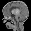 1A3 ALK-positive Histiocytosis (Case 1) T1 with C sagittal - Copy