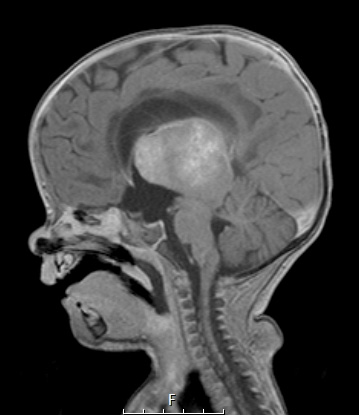 1A3 ALK-positive Histiocytosis (Case 1) T1 with C sagittal - Copy