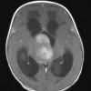 1A4 ALK-positive Histiocytosis (Case 1) T1 with C - Copy