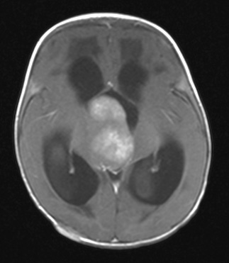 1A4 ALK-positive Histiocytosis (Case 1) T1 with C - Copy