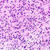 ALK Fusion Histiocytosis