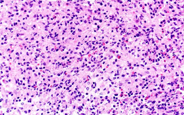 1B1 ALK-positive Histiocytosis (Case 1) A1 H&E 40X 1