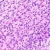 1B2 ALK-positive Histiocytosis (Case 1) A3 H&E 40X 4