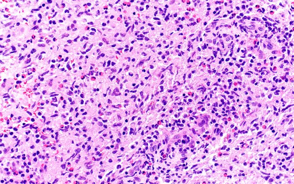 1B2 ALK-positive Histiocytosis (Case 1) A3 H&E 40X 4