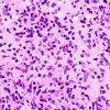 1B3 ALK-positive Histiocytosis (Case 1) A3 H&E 60X 1