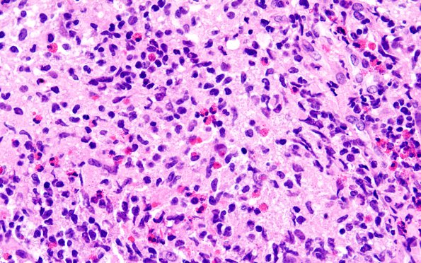 1B3 ALK-positive Histiocytosis (Case 1) A3 H&E 60X 1