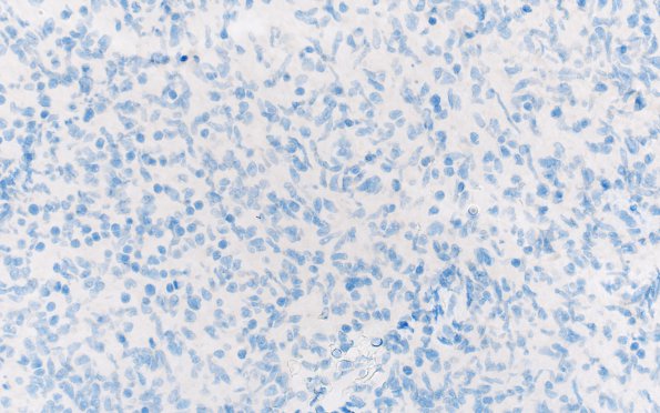 1D ALK-positive Histiocytosis (Case 1) CD1a 40X 1