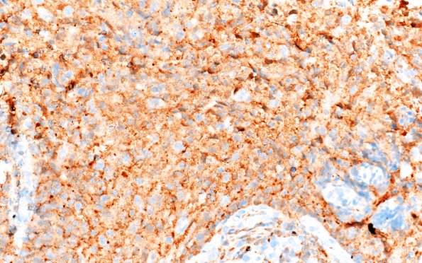 1E ALK-positive Histiocytosis (Case 1) Factor XIIIa 40X 3