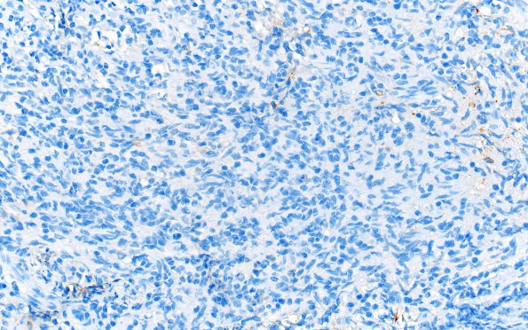 1F ALK-positive Histiocytosis (Case 1) S100 40X 2