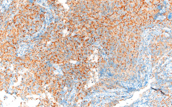 1G1 ALK-positive Histiocytosis (Case 1) Alk-1 20