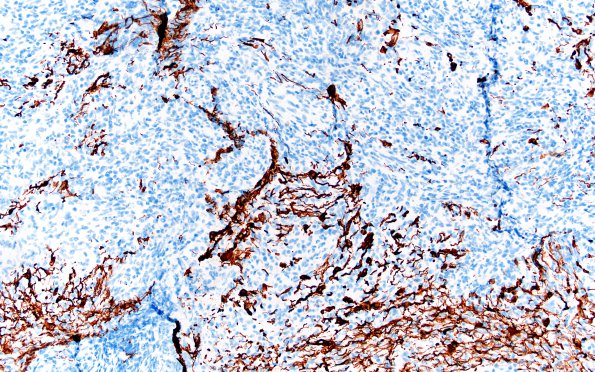 1H1 ALK-positive Histiocytosis (Case 1) GFAP 20X 3