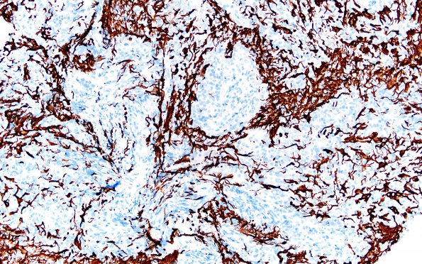 1H2 ALK-positive Histiocytosis (Case 1) GFAP 20X 1