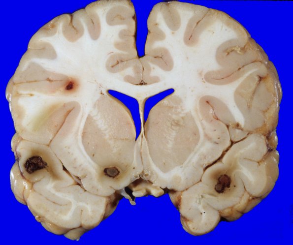 1A1 Leukemia Nodules, AMML (Case 1) 6