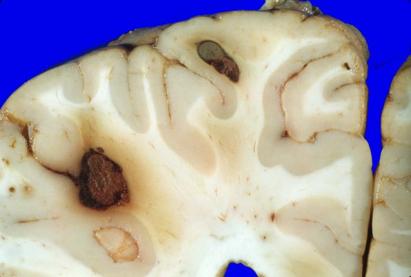 1A2 Leukemia, nodules AMML (Case 1) 2