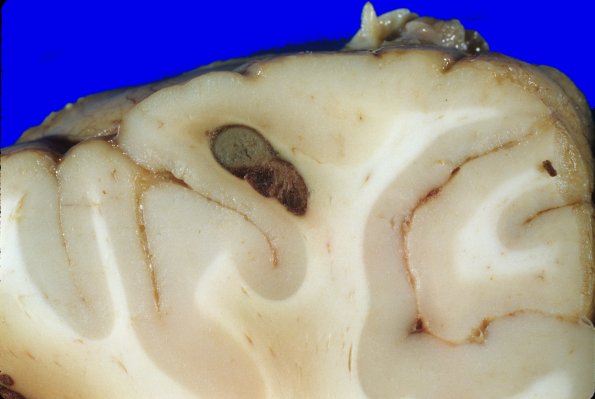 1A3 Leukemia, nodules AMML (Case 1) 1