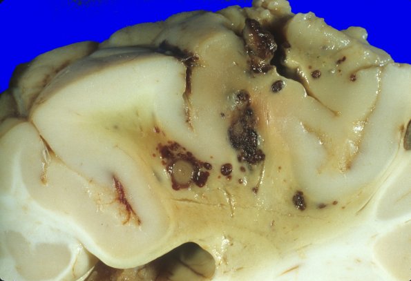 1A4 Leukemia, nodules AMML (Case 1) 4