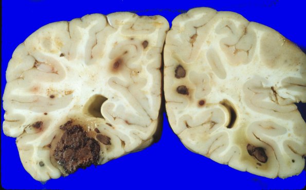1A5 Leukemia Nodules, AMML (Case 1) 7